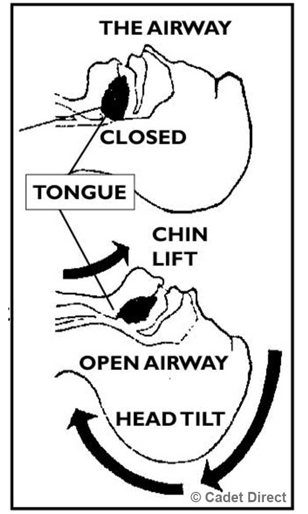 First Aid Head Tilt First Aid Head Tilt